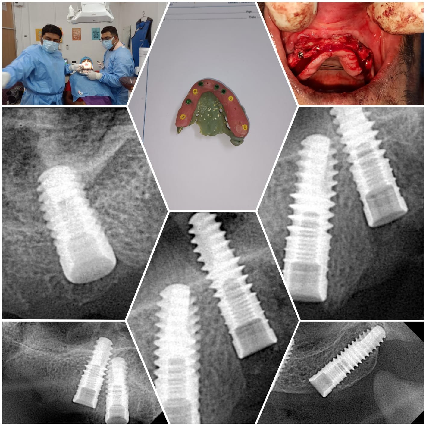 full mouth upper arch dental implant placement